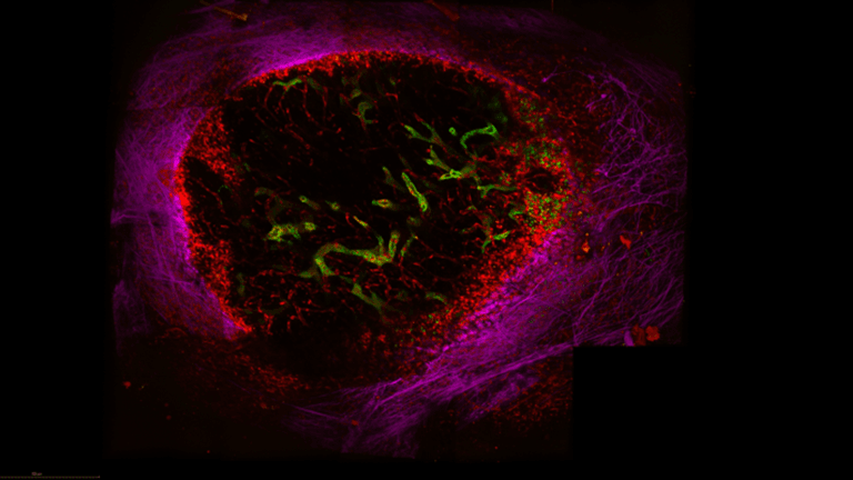 The Mechanism of Cancer Cells Escaping the Immune System Revealed